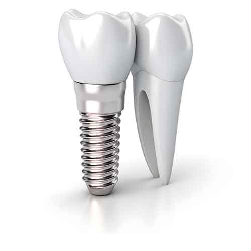 implante-dental-em-palmas-tocantins
