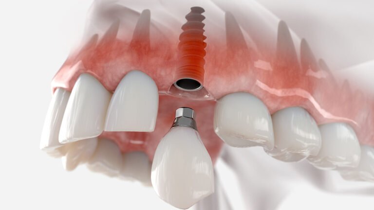 post-implante-dentário-palmas